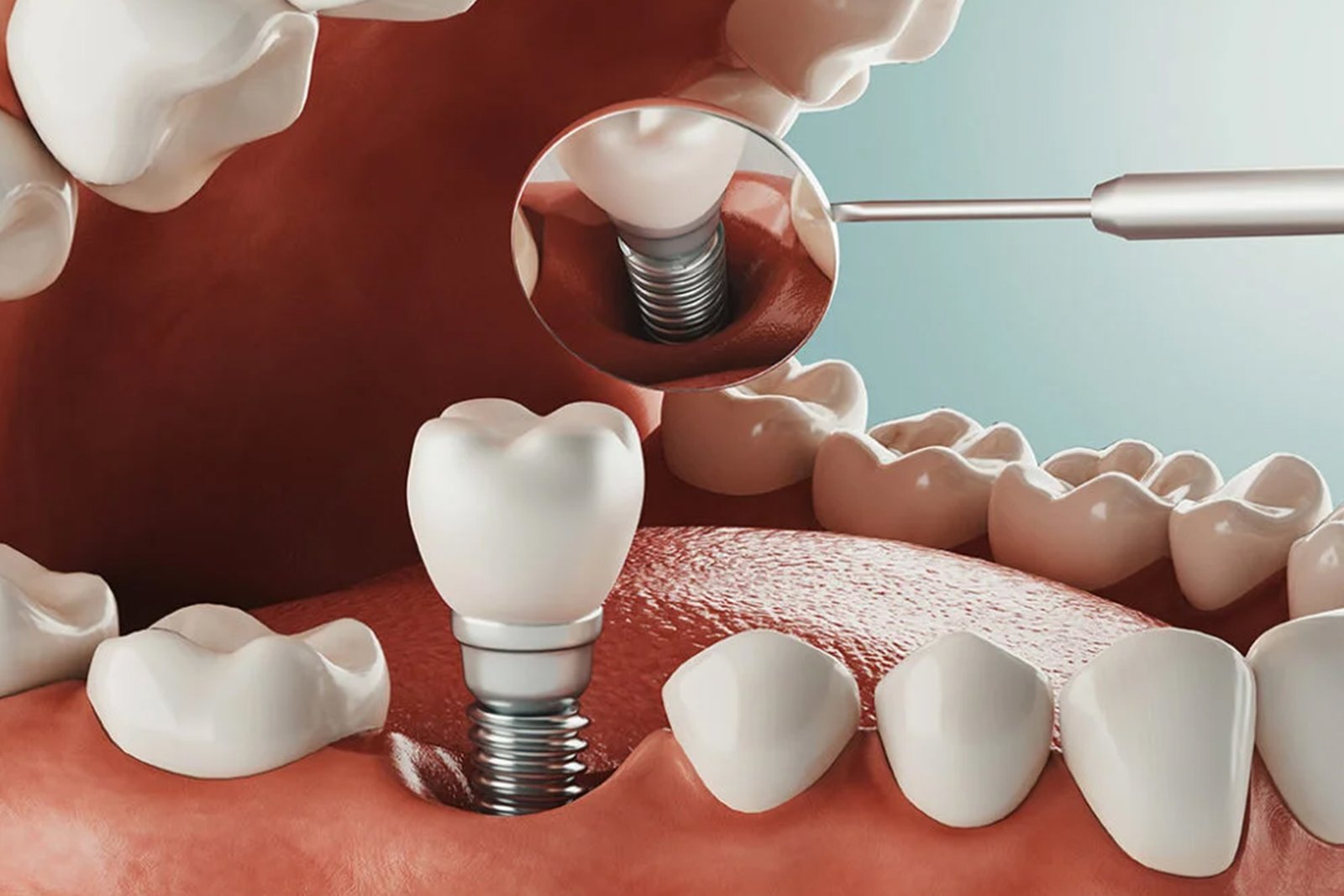 Dental implants