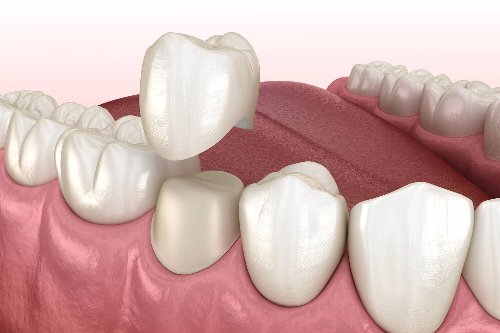Veneers
