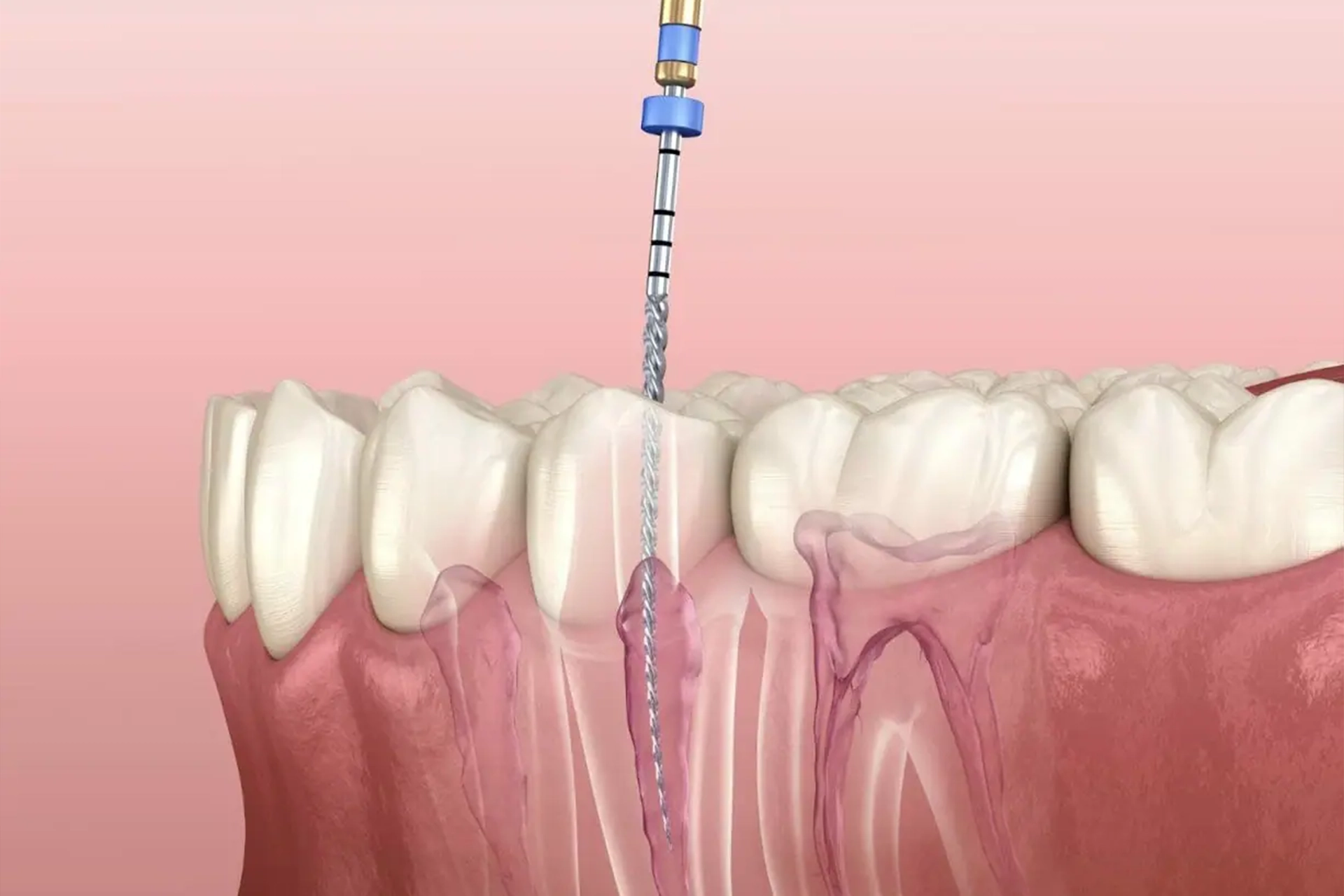 Dental Filling