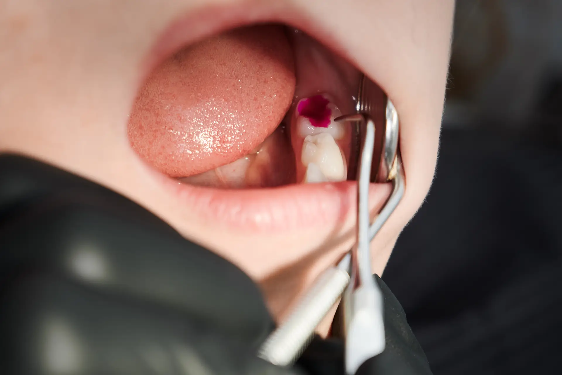 Dental nerve filling