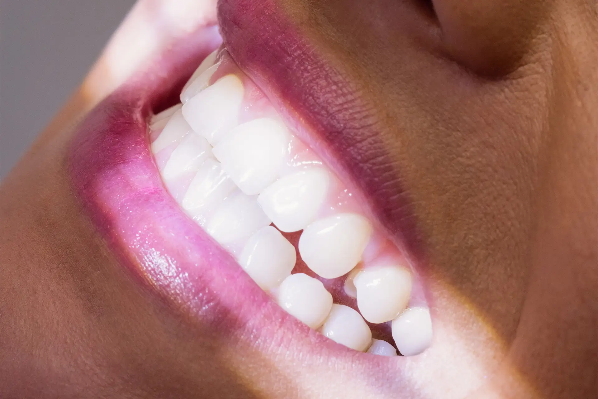 Teeth whitening