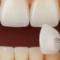Dental Veneers: A Natural Way to Improve Your Smile